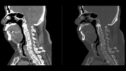 A CT scan of the neck sagittal view for diagnostic technique is essential f.. Stock Illustration