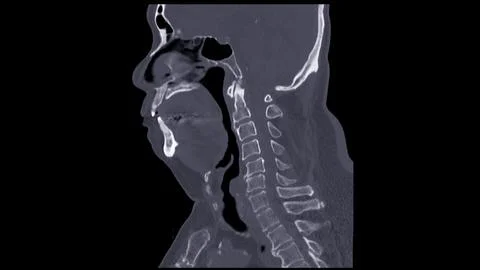 A CT scan of the neck sagittal view for diagnostic technique is essential f.. Stock Illustration