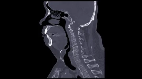 A CT scan of the neck sagittal view for diagnostic technique is essential f.. Stock Illustration