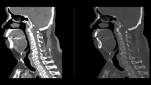 A CT scan of the neck sagittal view for diagnostic technique is essential f.. Stock Illustration