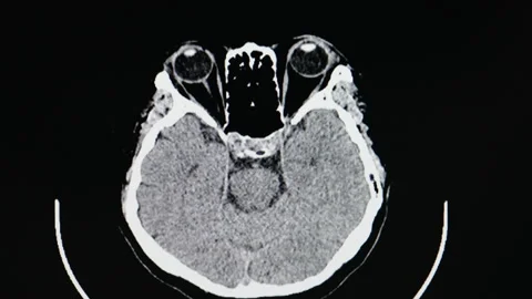CT scan of a patient with  brain atrophy and lacuna infarction Stock Footage 159476131