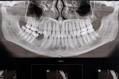 CT scan of a patient with missing chewing tooth and malocclusion Foto stock