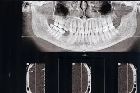 CT scan of a patient with missing chewing tooth and malocclusion Stock Photos