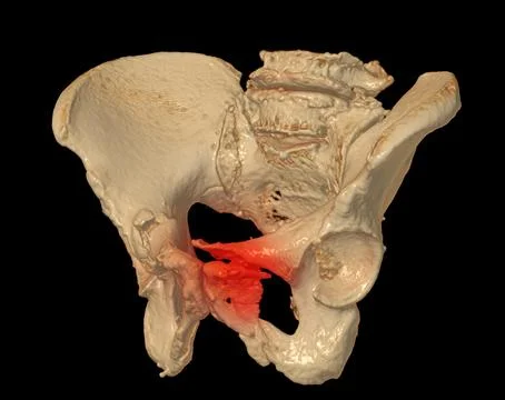 CT Scan of pelvic bone  3D rendering image showing superior pubic ramus fra.. Stock Illustration