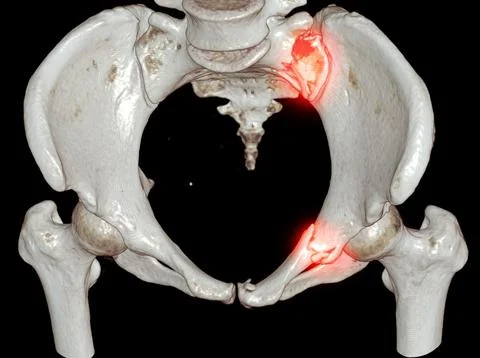 CT Scan pelvic bone with both hip joint 3D rendering  showign fracture of s.. Stock-Illustration