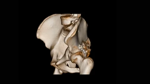 CT Scan pelvis 3D render Impression:Transverse fracture of acetabulum. Fractu Stock Footage 158902105