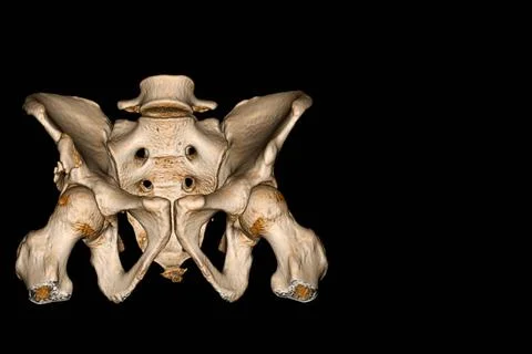 CT Scan of Pelvis 3D rendering image.showing :Myositis ossifican at muscle su Stock Illustration