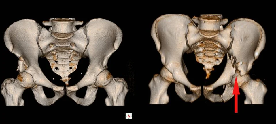 CT Scan pelvis Impression: - Transverse fracture of acetabulum. - Fracture Lt 库存插图