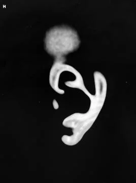 CT scan of pinna, ear cartilage - black,white Stock Photos