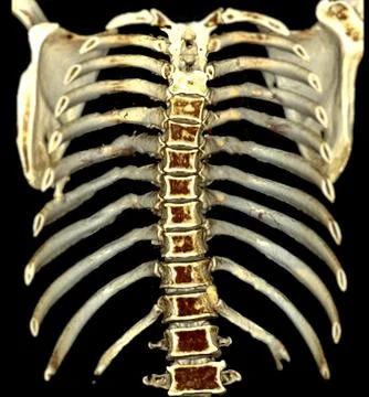 CT scan rib 3D rendering provides precise imaging of rib structures. Stock-Illustration