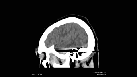 CT scan sagittal view with bullet fragmentation in brain male 20 year old Stock Footage 132925498