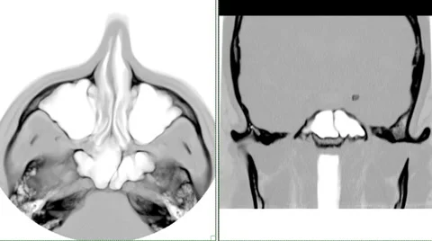 CT Scan Sequence: Split screen review of sinus cavities Stock Footage 37210663