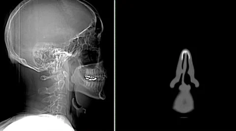 CT Scan Sequence: Split screen review of head Video stock 37212467