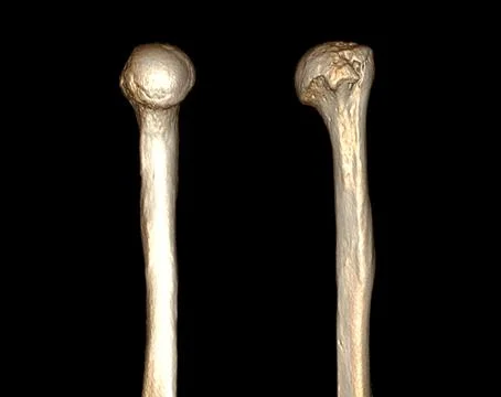 CT scan of shoulder joint and humerus bone or arm. 스톡 일러스트