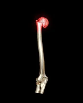 CT scan of shoulder joint and humerus bone or arm. Stock Illustration
