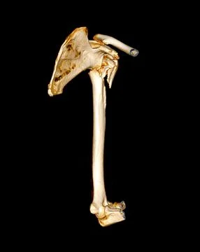 CT scan of shoulder joint and humerus bone or arm. Illustrazione stock