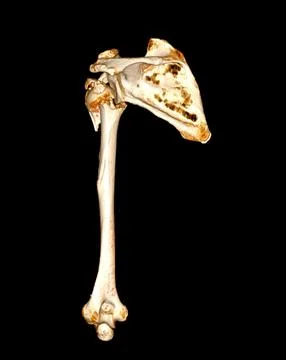 CT scan of shoulder joint and humerus bone or arm. Stock Illustration