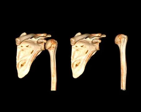 CT scan of shoulder joint. Stock-Illustration
