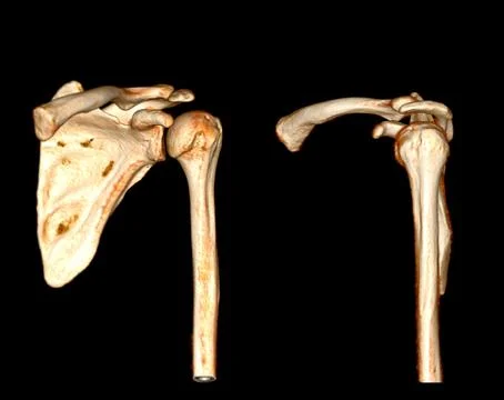 CT scan of shoulder joint. Stock Illustration