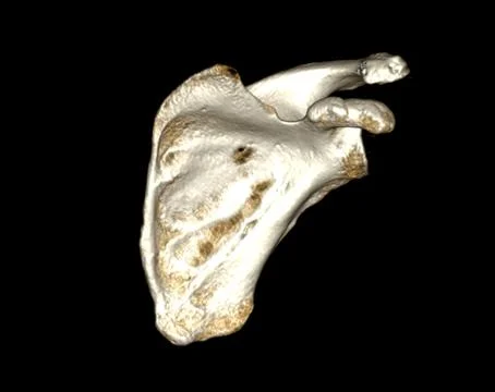 CT scan of shoulder joint. 스톡 일러스트