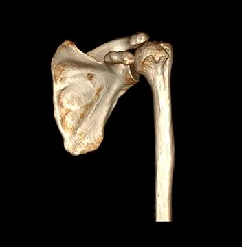 CT scan of shoulder joint. Stock Illustration