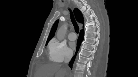 CT scan showing a man with metastasized prostate cancer Vidéo 64803989