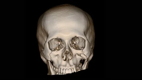 CT scan skull 3D render finding Multiple displaced fracture of right zygoma,  Stock Footage 158902109