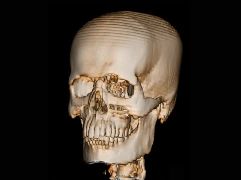 CT scan skull 3D render finding Multiple displaced fracture of right zygoma,  Stock Footage 158902164
