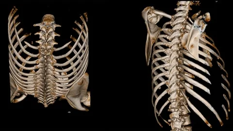 CT Scan Thoracic spine ct with 3D reconstruction . The film shown thoracolumb Stock Footage 158902154
