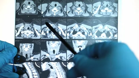 CT scan of the thyroid gland. MRI Stock Footage 289328381