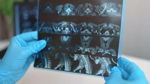 CT scan of the thyroid gland. MRI Stock Footage 289328522