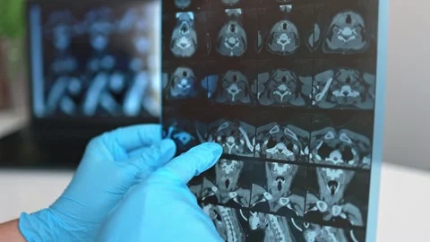 CT scan of the thyroid gland. MRI Stock Footage 289328645