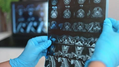 CT scan of the thyroid gland. MRI Stock Footage 289328708