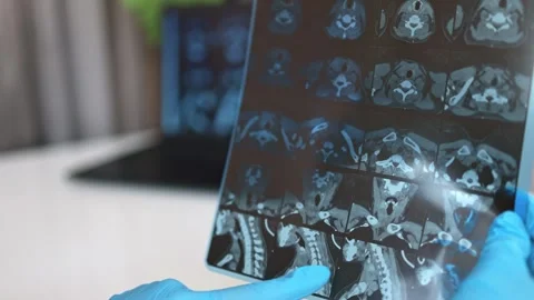 CT scan of the thyroid gland. MRI Stock Footage 289328804