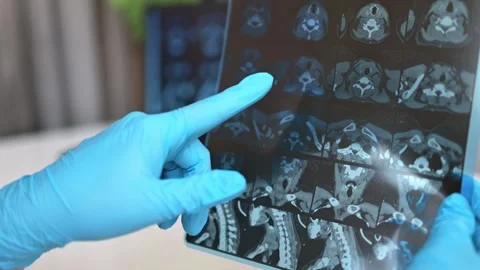 CT scan of the thyroid gland. MRI Stock Footage 289328826
