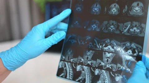 CT scan of the thyroid gland. MRI Stock Footage 289328842