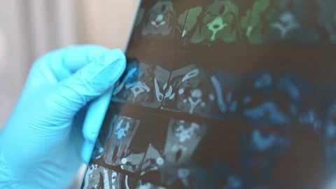 CT scan of the thyroid gland. MRI Stock Footage 289328890