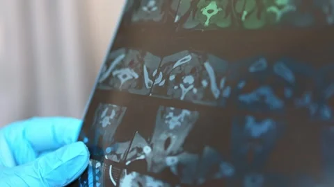 CT scan of the thyroid gland. MRI Stock Footage 289328952