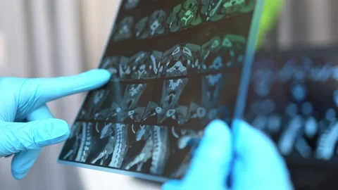 CT scan of the thyroid gland. MRI Stock Footage 289328965