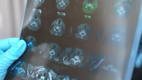 CT scan of the thyroid gland. MRI Stock Footage 289329018