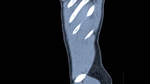 CT Scan Video Stock Footage 43258930