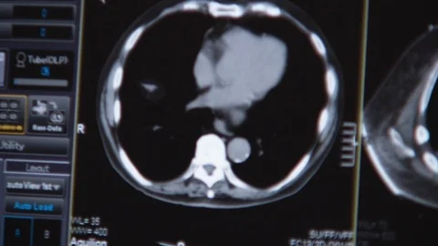 CT scanner screen blurred. Hospital reviewing data of patient A Stock Footage 115503544