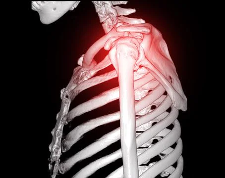 CT Shoulder 3D 스톡 일러스트