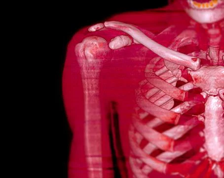 CT Shoulder 3D rendering . Stock Illustration