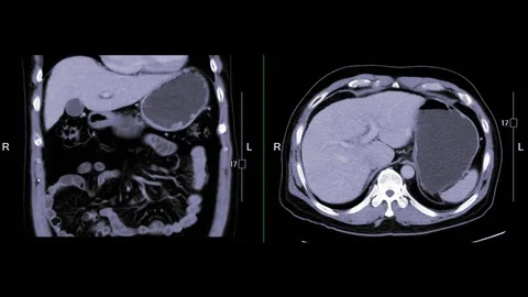 CT  Upper abdomen with contrast  media 스톡 동영상 106673376