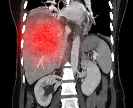 CT upper abdomen coronal view showing  DDX is atypical HCC or hepatocellula.. Stock Illustration