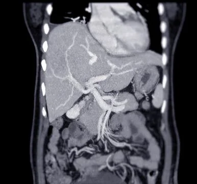 CT upper abdomen coronal view. Stock Illustration