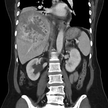 CT upper abdomen coronal view showing  DDX is atypical HCC or hepatocellula.. Stock Illustration