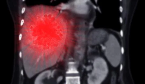 CT upper abdomen coronal view showing  DDX is atypical HCC or hepatocellula.. Stock-Illustration
