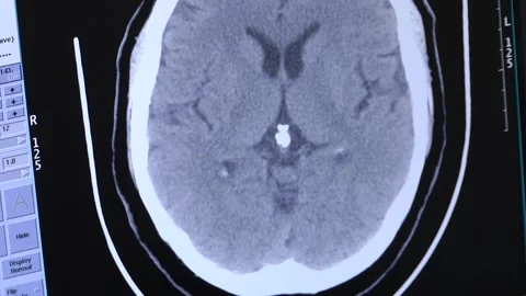CT X-ray Scan on Human Brain Video stock 97849197